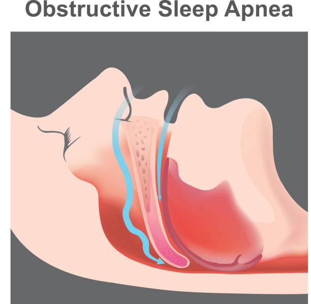 Dangers of Untreated Sleep Apnea.